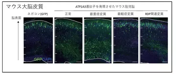 「大脳皮質形成異常症の１つである「多小脳回」（病的に小さい脳回が多発する病気）の新たな原因遺伝子ATP1A3を同定」の画像