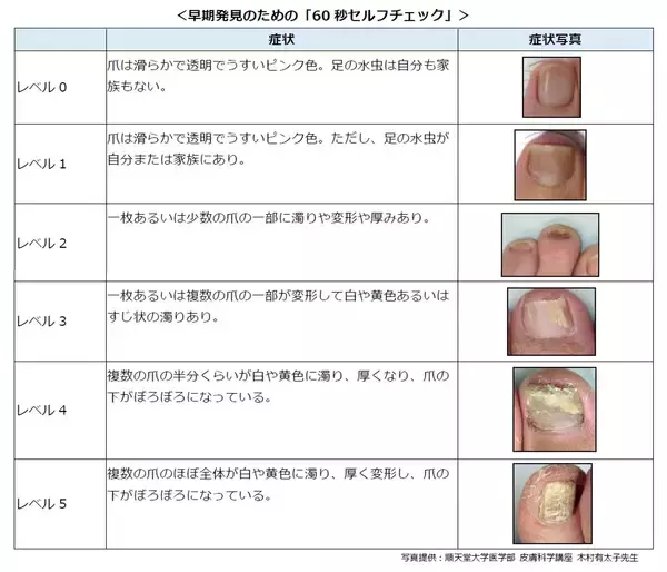 あなたの爪は大丈夫？1月7日の「爪切りの日」を前に考える足の健康管理　女性にも多い爪水虫、早期発見のための「60秒セルフチェック」