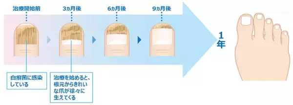 「あなたの爪は大丈夫？1月7日の「爪切りの日」を前に考える足の健康管理　女性にも多い爪水虫、早期発見のための「60秒セルフチェック」」の画像