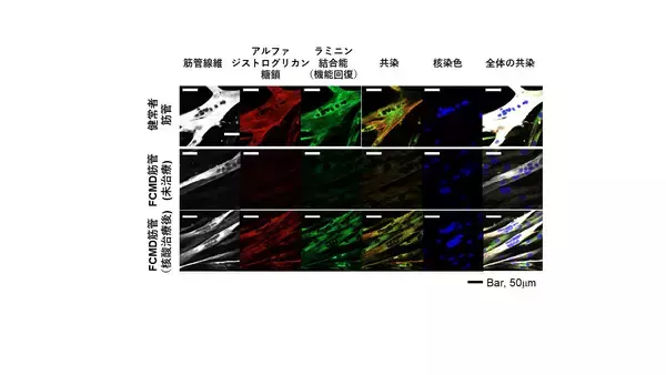 日本人に特に多い福山型筋ジストロフィーの重症型の患者さんに対する新しい根治治療療法につながる発見