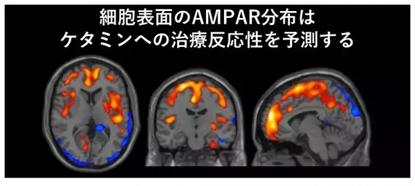 「【横浜市立大学】ケタミンがうつ症状を改善する仕組みを解明」の画像