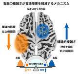 「【昭和医科大学】左脳の脳腫瘍による言語障害の個人差を解明 ― 右半球の「構造的複雑さ」が言語処理速度を維持する予備能として機能する可能性を示唆 ―」の画像1