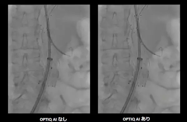 「シーメンスヘルスケア、AIを用いた画像処理技術を搭載したX線透視・撮影装置「ARTIS pheno.vision」を発売」の画像