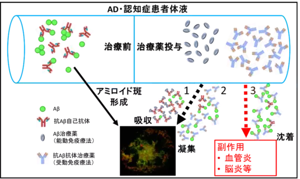 「【東京医科大学】アルツハイマー病のアミロイド斑内における自己抗体の存在とその意義 ～抗体の二面性と治療薬開発におけるピットフォール～」の画像