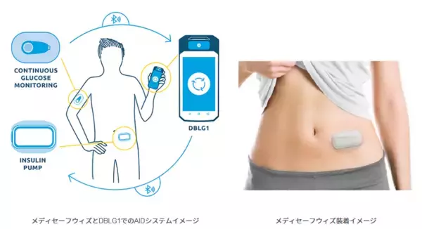 インスリン注射が自動で行える、画期的システム開発が開始される