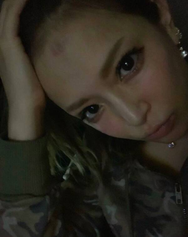 浜崎あゆみ おでこに火傷のあと残る写真公開に心配の声 痛そうー 18年9月29日 エキサイトニュース