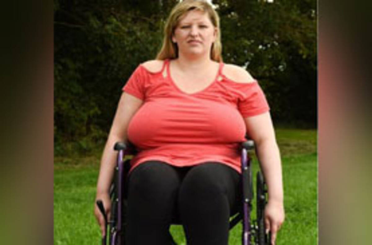 知られざる苦しみ 胸が大きすぎて重さで背骨が曲がってしまった女性 車椅子生活に 年9月15日 エキサイトニュース