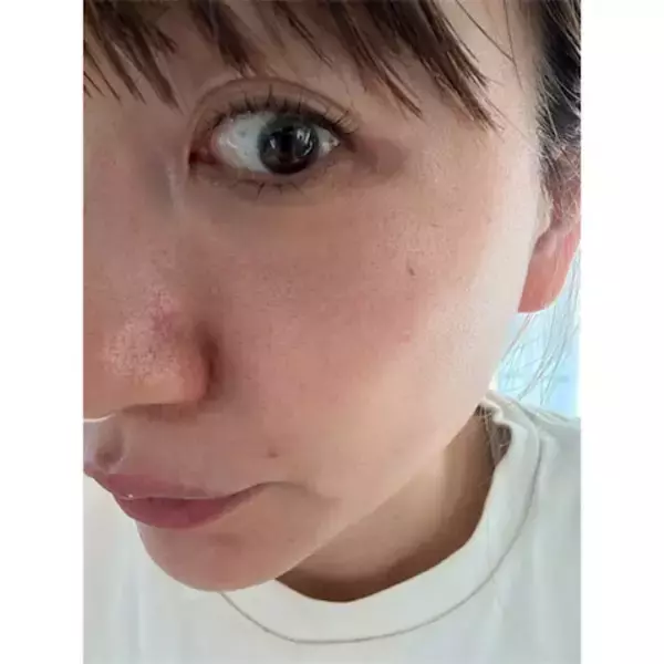 あいのり･桃、美容医療後"ダウンタイム5日目"のドアップショット「顔が…ザラザラしています…！」