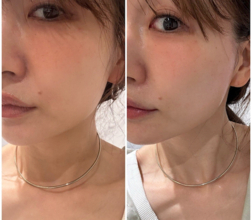 あいのり・桃、糸リフト施術後の変化に驚き＆ビフォアフ写真も公開「違いが凄い！！」