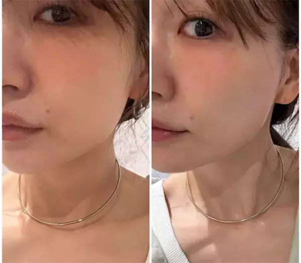 あいのり・桃、糸リフト施術後の変化に驚き＆ビフォアフ写真も公開「違いが凄い！！」
