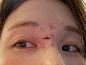 はんにゃ川島の元妻･川島菜月、深夜に体調急変＆倒れて顔に…