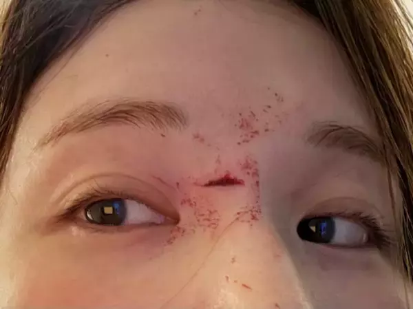 はんにゃ川島の元妻･川島菜月、深夜に体調急変＆倒れて顔に…