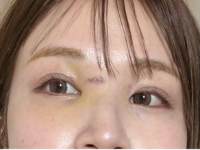 はんにゃ川島の元妻･川島菜月、顔の傷の抜糸報告「病院なう…」