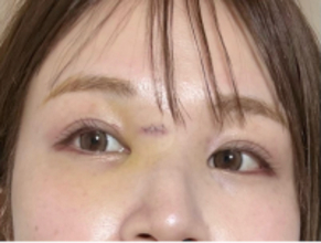 はんにゃ川島の元妻･川島菜月、顔の傷の抜糸報告「病院なう…」