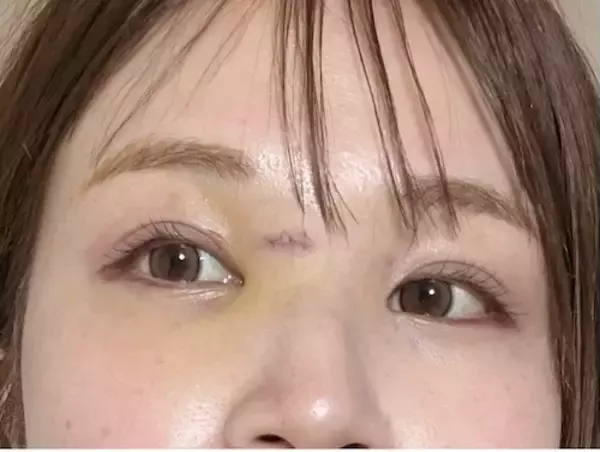 「はんにゃ川島の元妻･川島菜月、顔の傷の抜糸報告「病院なう…」」の画像