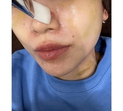 あいのり・桃、医師も驚く“ニキビ治療”を報告