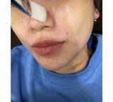 「あいのり・桃、医師も驚く“ニキビ治療”を報告」の画像2