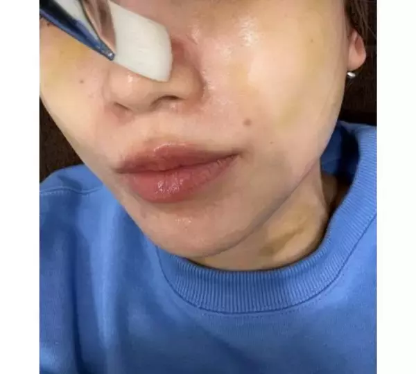 「あいのり・桃、医師も驚く“ニキビ治療”を報告」の画像