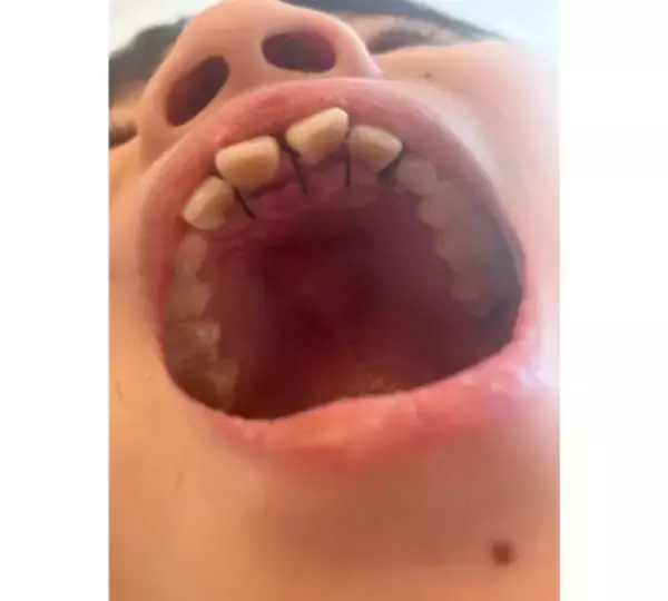 「ココリコ遠藤の妻、次男の矯正を悩む「うちの子、どうしようかなぁ」」の画像