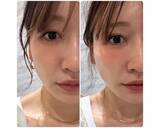 「あいのり・桃、糸リフト施術後の変化に驚き＆ビフォアフ写真も」の画像1