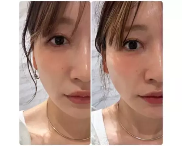 「あいのり・桃、糸リフト施術後の変化に驚き＆ビフォアフ写真も」の画像