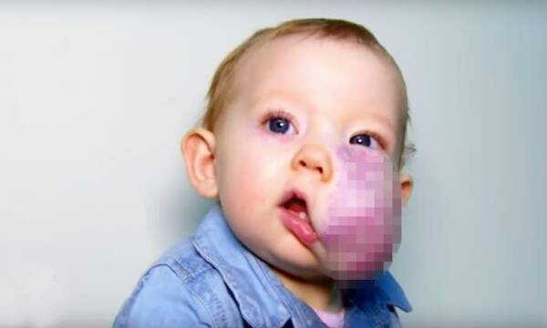 巨大腫瘍を持った赤ちゃん 驚きのビフォーアフター 19年8月日 エキサイトニュース