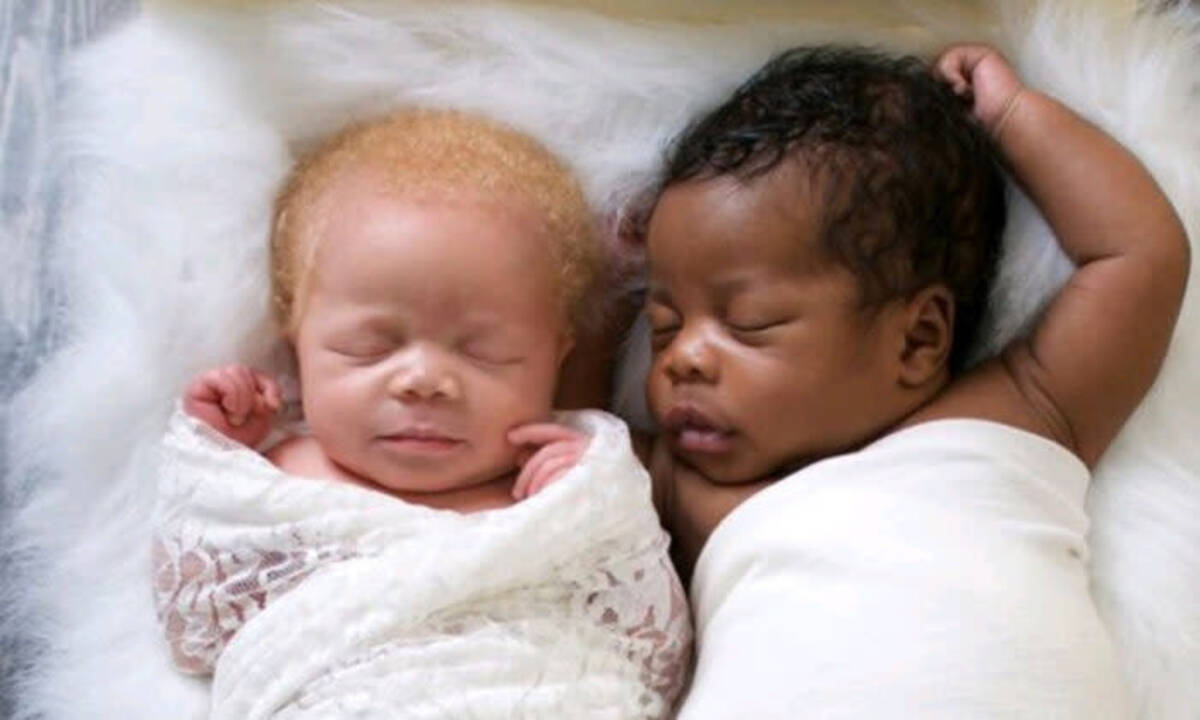 超希少 黒人とアルビノの双子を出産したフォトグラファーの母親が写真に込める思い 年7月13日 エキサイトニュース