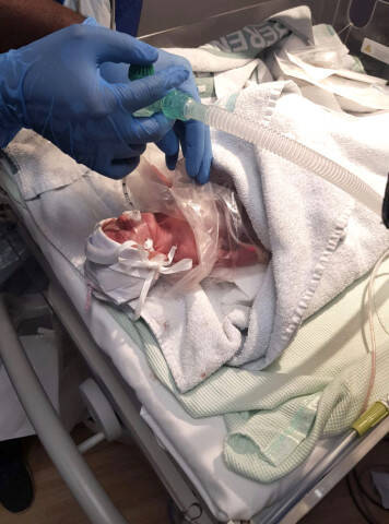 妊娠25週目で生まれた女の子の赤ちゃん 無事退院 年7月23日 エキサイトニュース