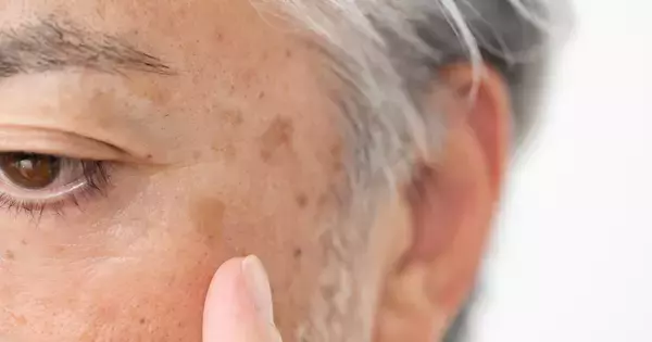 40代後半のおじさん肌にできたシミ、放っておくとどうなる?