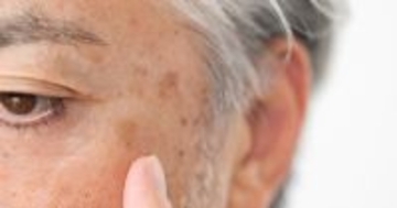 40代後半のおじさん肌にできたシミ、放っておくとどうなる?