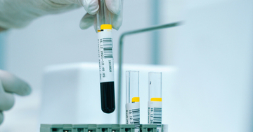 O型はがんになりにくい? 100万人を調査して分かった、血液型と発症リスクの差