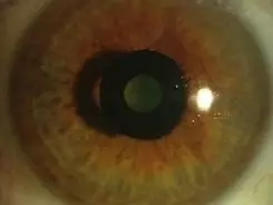 リングを入れるだけの画期的な老眼治療法が出た