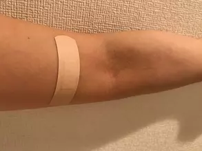 アルコールパッチテストって、どの程度正確なの？