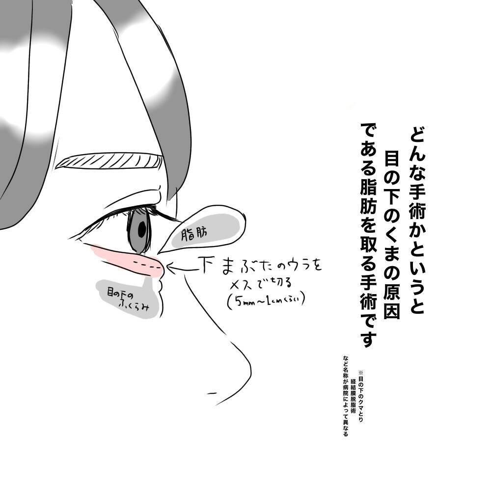 「具合悪いの？」目の下にクマがあると人に心配される…私が整形を決断した理由