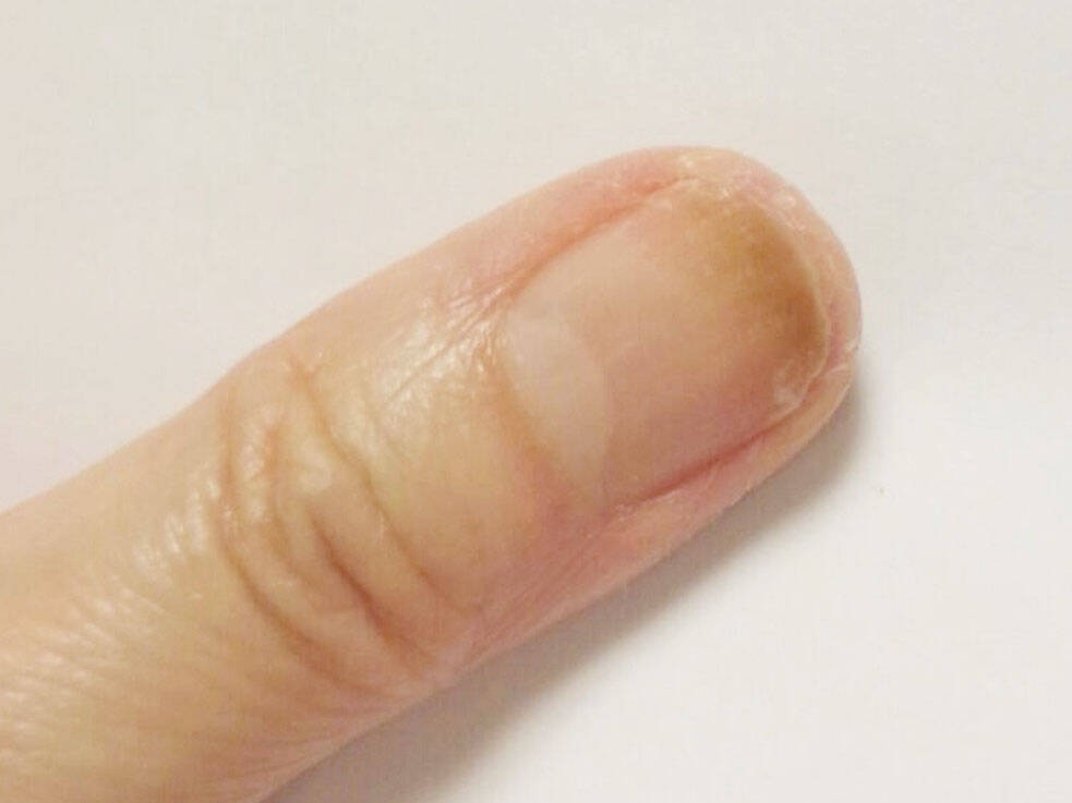 爪が緑に変色 ジェルネイルで起きるリスク グリーンネイル の原因と対処法 17年3月1日 エキサイトニュース
