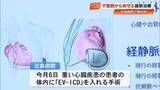 「高知県初の手術、心臓に『EV-ICD』不整脈感知で電気　感染症リスク低く昨年保険適用」の画像1