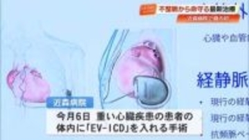 高知県初の手術、心臓に『EV-ICD』不整脈感知で電気　感染症リスク低く昨年保険適用