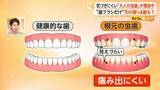 「気づきにくい「大人の虫歯」“歯ブラシだけ”汚れ残り4割　歯科医が伝授する持ち方やすすぎ方、ブラシの選び方も」の画像1