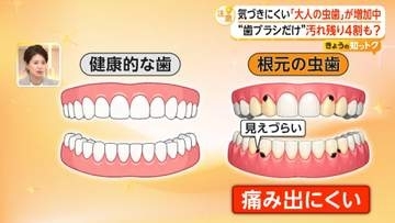 気づきにくい「大人の虫歯」“歯ブラシだけ”汚れ残り4割　歯科医が伝授する持ち方やすすぎ方、ブラシの選び方も