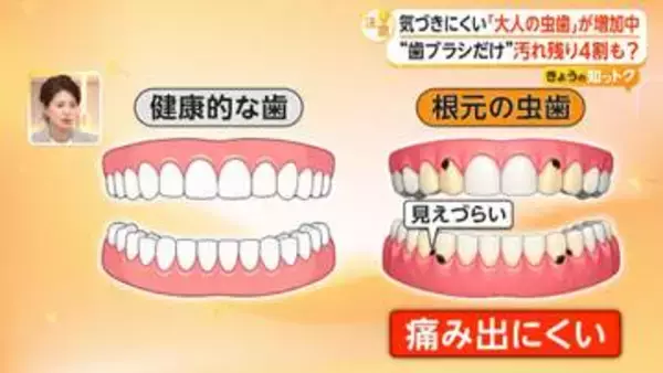 気づきにくい「大人の虫歯」“歯ブラシだけ”汚れ残り4割　歯科医が伝授する持ち方やすすぎ方、ブラシの選び方も