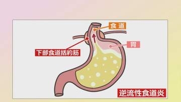 放置するとがんになる可能性も　成人の10〜20%が発症する「逆流性食道炎」　食事の度に“口の中が酸っぱい”は要注意