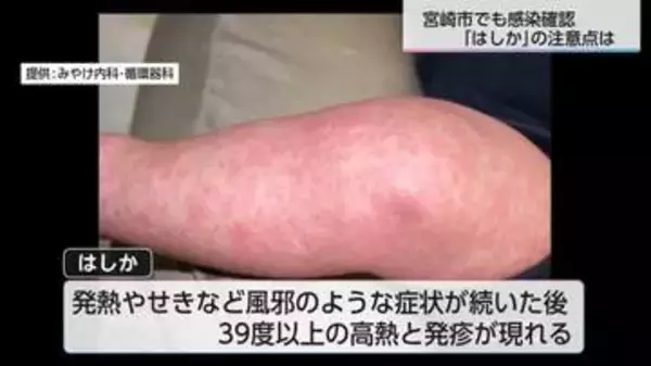 感染力はインフルエンザの約10倍!?　宮崎市で7年ぶりの｢はしか｣感染を確認　驚異の感染力から身を守るために今できること