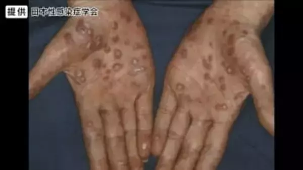 性感染症「梅毒」が全国で急増　SNS、マッチングアプリでの出会いが一因か　地方でも拡大…男性20～40代、女性20～30代に多く　長野県で“過去最多”4年連続更新