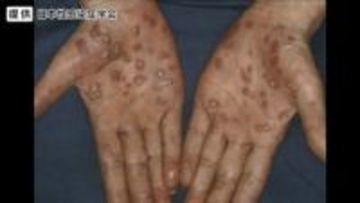 性感染症「梅毒」が全国で急増　SNS、マッチングアプリでの出会いが一因か　地方でも拡大…男性20～40代、女性20～30代に多く　長野県で“過去最多”4年連続更新