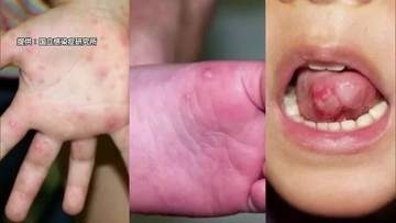 2歳以下の子どもの感染8割以上　「手足口病」流行で2年ぶりに警報　ワクチン・予防薬がない夏の感染症に適切な対処を