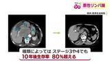 「ステージ4でも「治癒が期待できる」悪性リンパ腫　10年後生存率は80％超　がん細胞を“狙い撃ち”する注目の治療法」の画像1