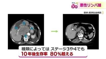 ステージ4でも「治癒が期待できる」悪性リンパ腫　10年後生存率は80％超　がん細胞を“狙い撃ち”する注目の治療法