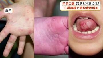 【小児科医に聞く】手足口病「便からは４週間ウイルスを出す」　予防と対策のポイント