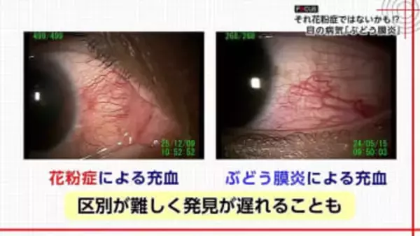 失明の恐れも…『花粉症と酷似』年間5万人発症の“目の病気”「ぶどう膜炎」　「見分け方」と「早期受診の重要性」を専門医に聞いた