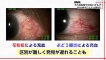 失明の恐れも…『花粉症と酷似』年間5万人発症の“目の病気”「ぶどう膜炎」　「見分け方」と「早期受診の重要性」を専門医に聞いた